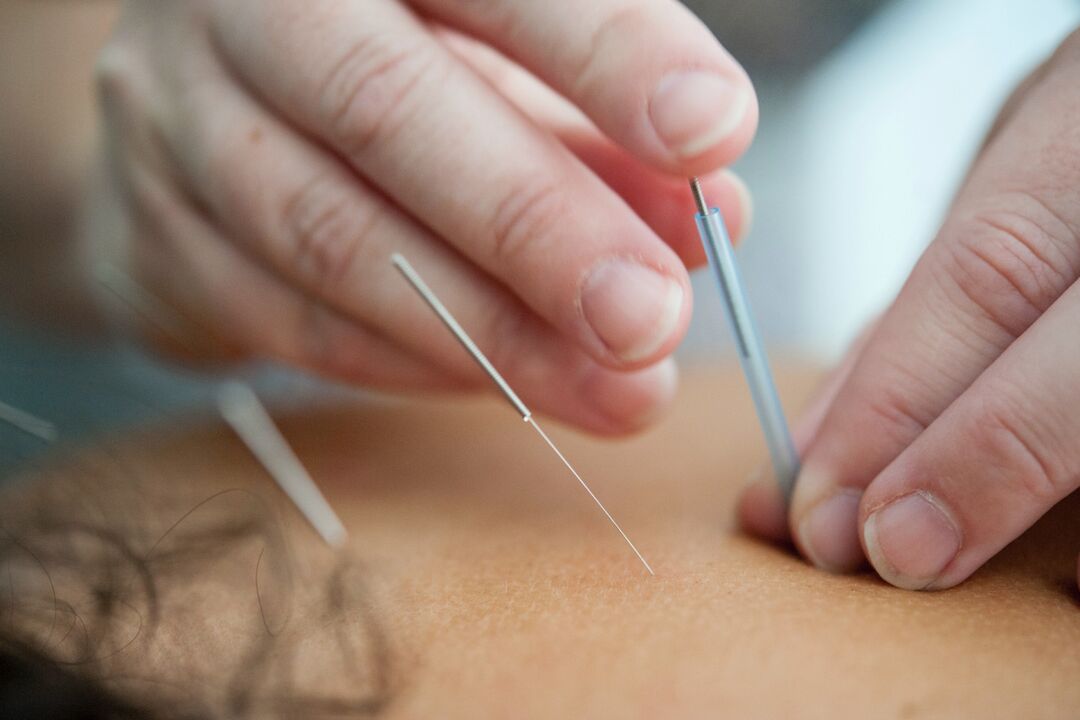 A acupuntura é un xeito ineficaz de deixar de fumar
